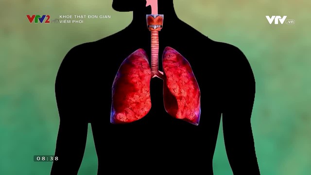 Khỏe thật đơn giản: Viêm phổi